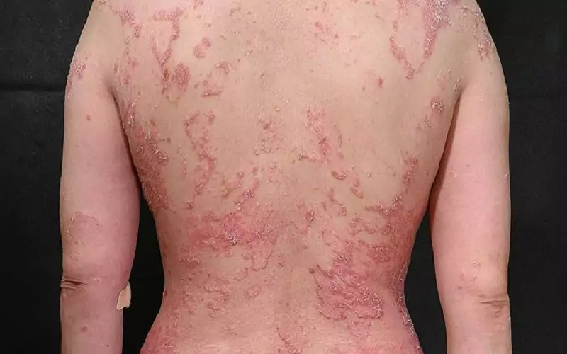 Vẩy nến toàn thân