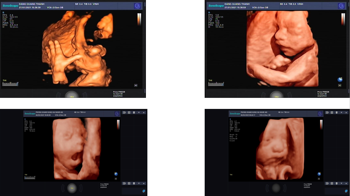 Ảnh 5D máy siêu âm SonoScape P25 Ảnh 5D máy siêu âm SonoScape P25