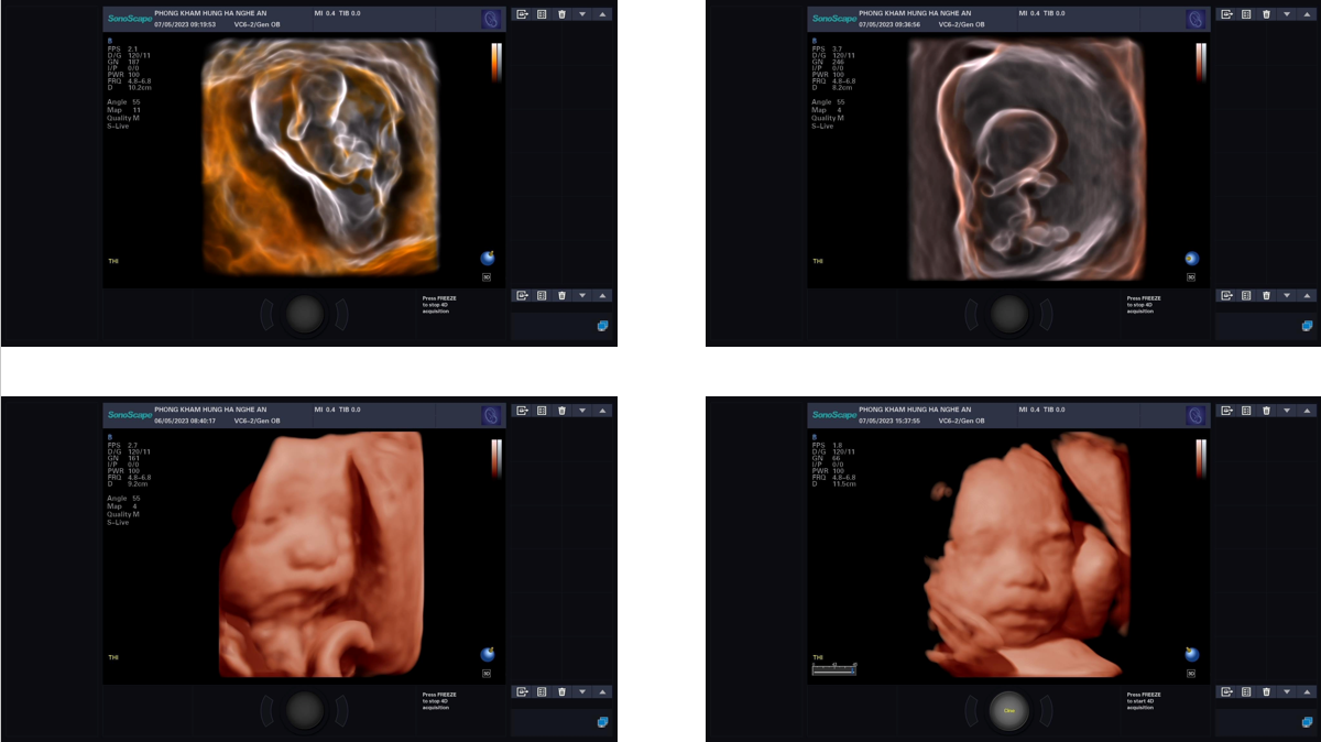 Hình ảnh 5D trên máy SonoScape P25