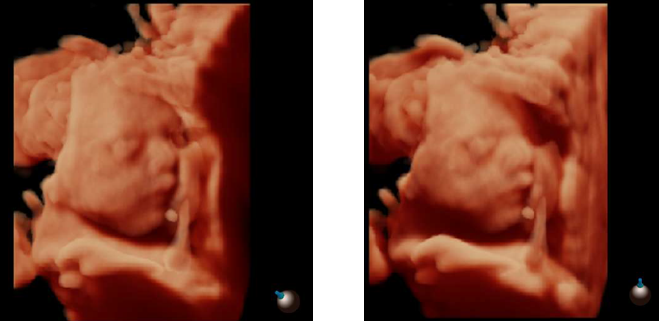 máy siêu âm 4d 5d sonoscape M22 máy siêu âm 5D