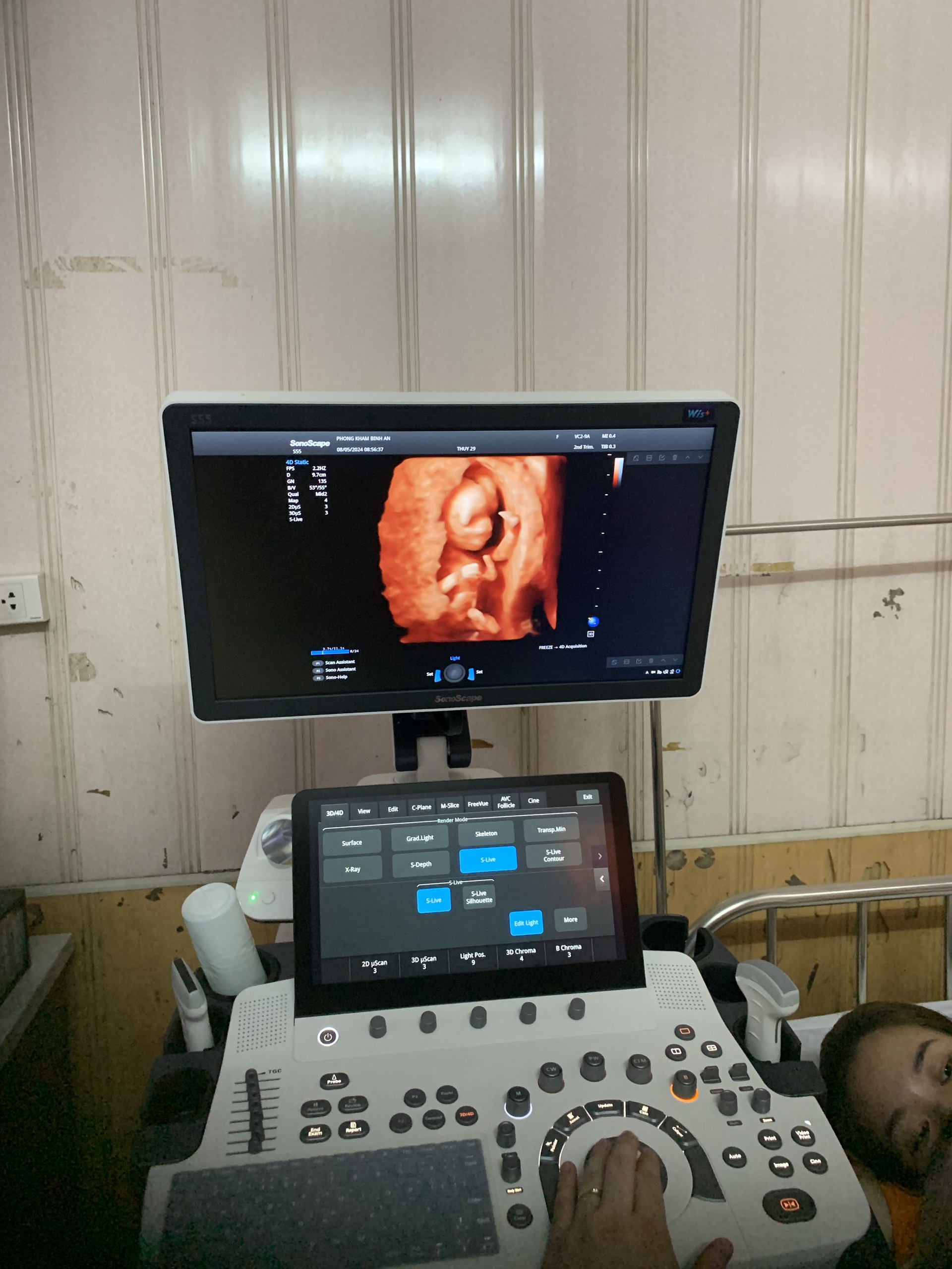 Máy siêu âm SonoScape S55 Máy siêu âm SonoScape S55