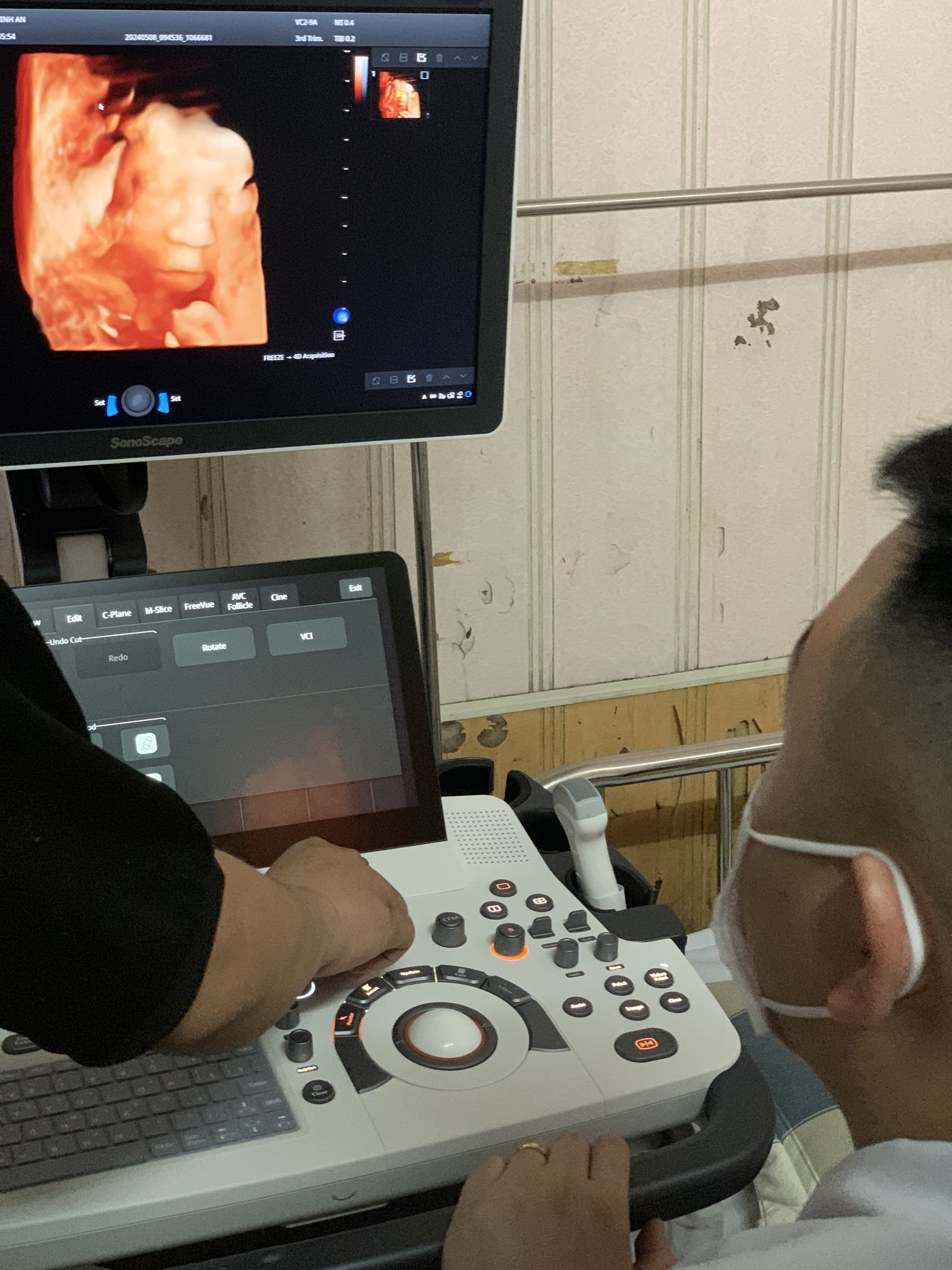 Máy siêu âm SonoScape S55 Máy siêu âm SonoScape S55