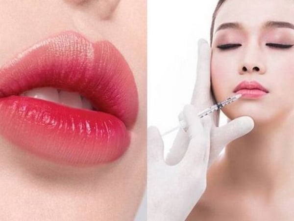 Tiêm môi trái tim có an toàn không? Giải đáp chi tiết từ chuyên gia thẩm mỹ