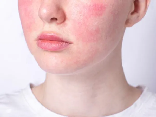 Da yếu sau treatment: Cách phục hồi đúng chuẩn y khoa