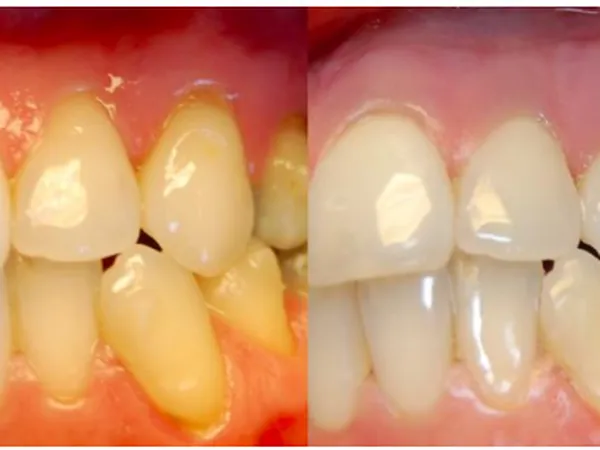 Reduction in Gingival Bleeding after Atelocollagen Injection in Patients with Hashimoto’s Disease
