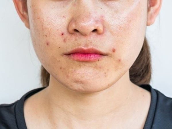 Da đổ dầu nhiều: Nguyên nhân & cách kiểm soát hiệu quả từ góc nhìn chuyên môn