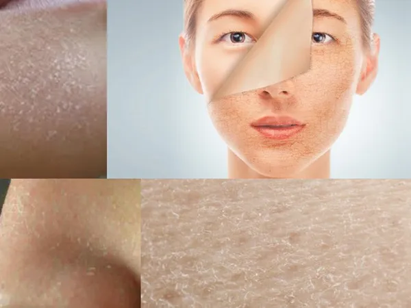 5 dấu hiệu cho thấy da bạn đang thiếu collagen – Cảnh báo lão hóa sớm nhiều người bỏ qua