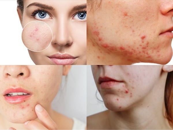 Mụn nội tiết có tự hết không? Giải đáp từ góc nhìn chuyên môn da liễu