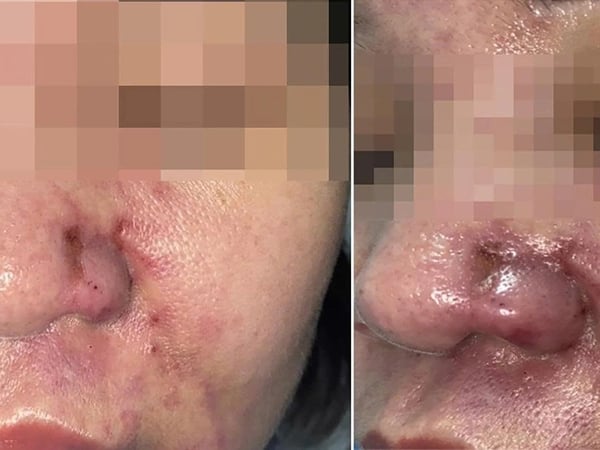 Những Biến Chứng Thẩm Mỹ Bạn Cần Biết – Đừng Đánh Đổi Làn Da Chỉ Vì Làm Đẹp Nhanh