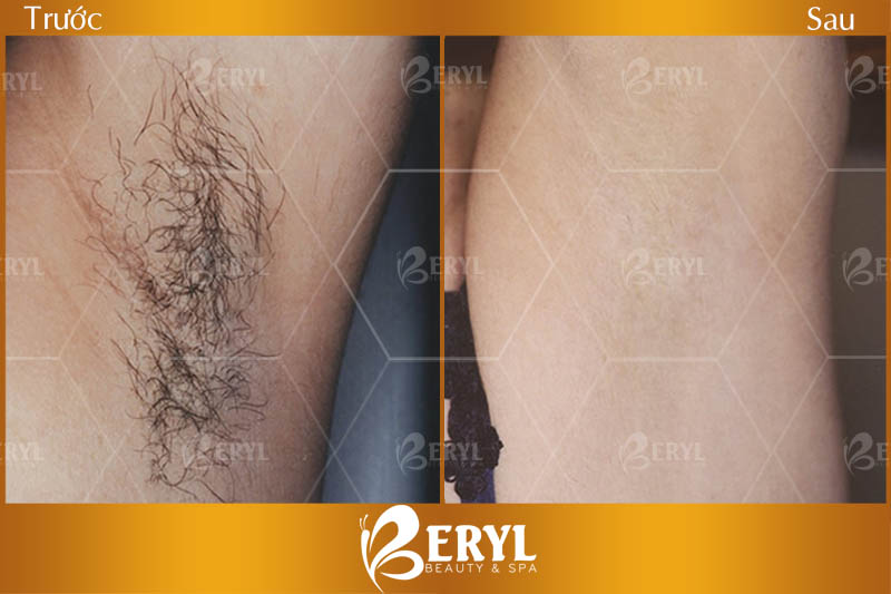 Hình ảnh trước và sau khi triệt lông nách với giá hợp lý tại Beryl Beauty & Spa Hình ảnh trước và sau khi triệt lông nách với giá hợp lý tại Beryl Beauty & Spa