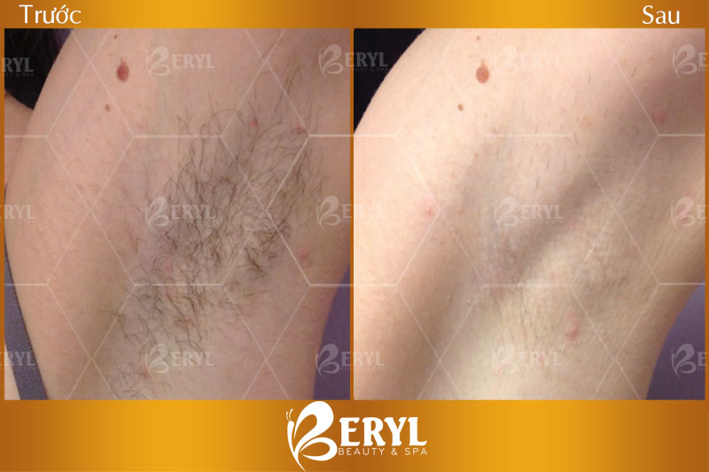 Hình ảnh trước và sau khi triệt lông nách giá hợp lý mà hiệu quả tại Beryl Beauty & Spa Hình ảnh trước và sau khi triệt lông nách giá hợp lý mà hiệu quả tại Beryl Beauty & Spa