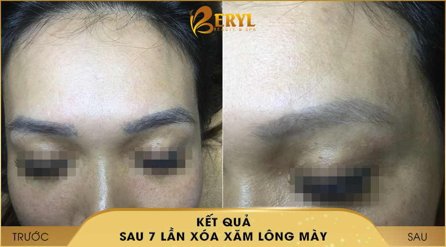 Trước và sau khi xóa xăm lông mày bằng CN Laser Alphatech Pro tại Beryl Beauty & Spa Trước và sau khi xóa xăm lông mày bằng CN Laser Alphatech Pro tại Beryl Beauty & Spa