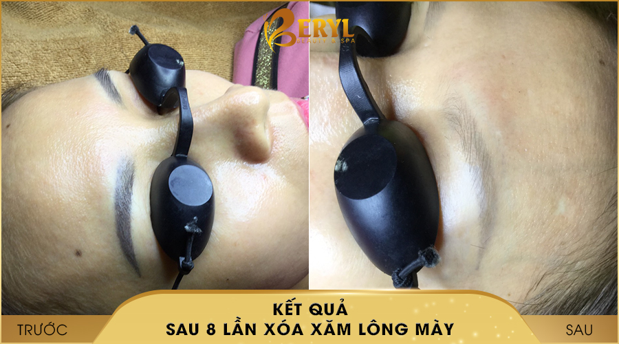 Trước và sau khi xóa xăm lông mày bằng CN Laser Alphatech Pro tại Beryl Beauty & Spa Trước và sau khi xóa xăm lông mày bằng CN Laser Alphatech Pro tại Beryl Beauty & Spa