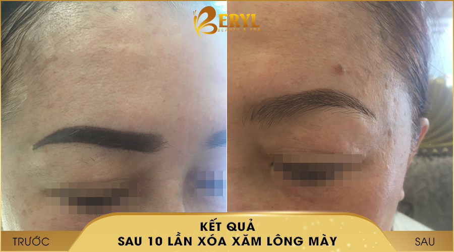 Trước và sau khi xóa xăm lông mày bằng CN Laser Alphatech Pro tại Beryl Beauty & Spa Trước và sau khi xóa xăm lông mày bằng CN Laser Alphatech Pro tại Beryl Beauty & Spa