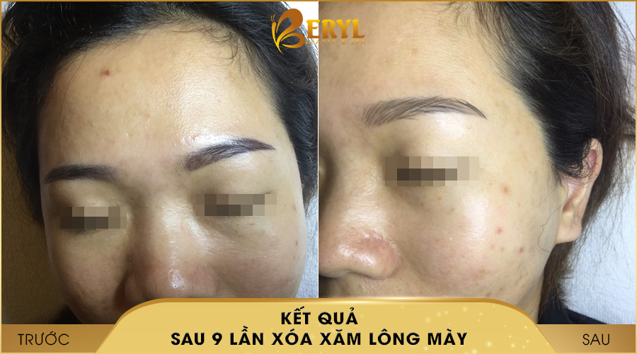 Trước và sau khi xóa xăm lông mày bằng CN Laser Alphatech Pro tại Beryl Beauty & Spa Trước và sau khi xóa xăm lông mày bằng CN Laser Alphatech Pro tại Beryl Beauty & Spa