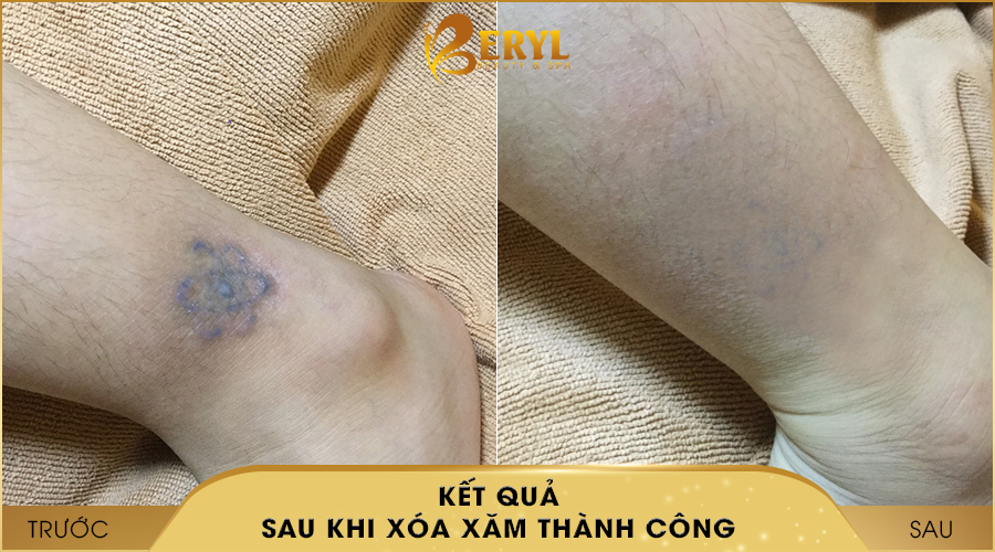 Hình ảnh trước và sau khi xóa hình xăm bằng CN đỉnh cao AlphaTech Pro tại Beryl Beauty & Spa Hình ảnh trước và sau khi xóa hình xăm bằng CN đỉnh cao AlphaTech Pro tại Beryl Beauty & Spa