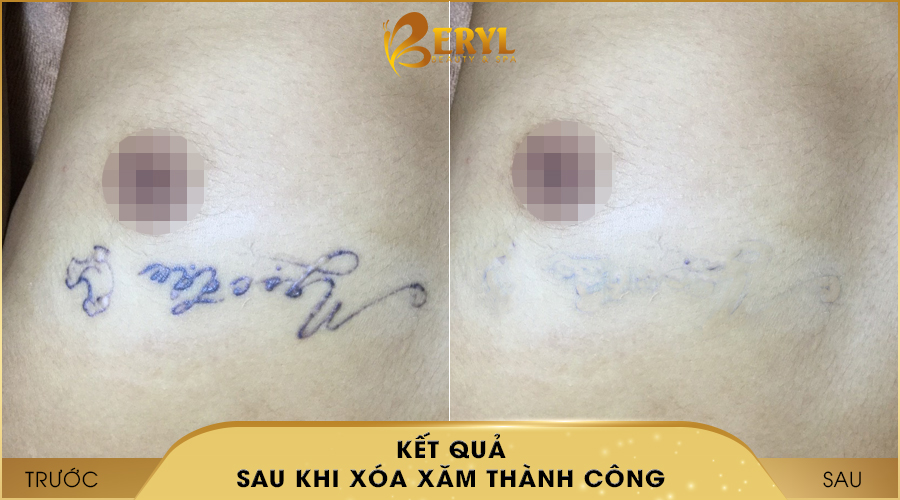 Hình ảnh trước và sau khi xóa hình xăm bằng CN đỉnh cao Alphatech Pro tại Beryl Beauty & Spa Hình ảnh trước và sau khi xóa hình xăm bằng CN đỉnh cao Alphatech Pro tại Beryl Beauty & Spa