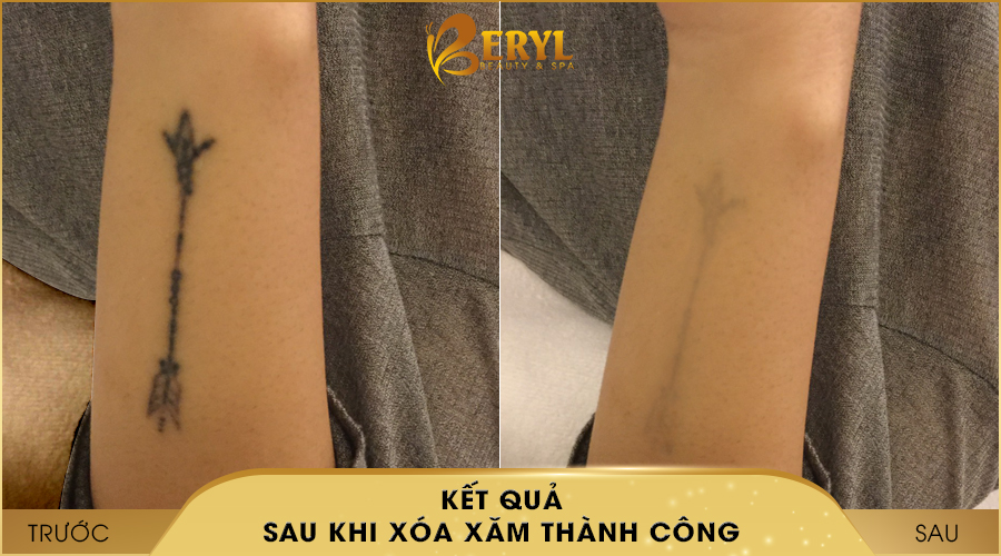 Hình ảnh trước và sau khi xóa hình xăm bằng CN đỉnh cao Alphatech Pro tại Beryl Beauty & Spa Hình ảnh trước và sau khi xóa hình xăm bằng CN đỉnh cao Alphatech Pro tại Beryl Beauty & Spa