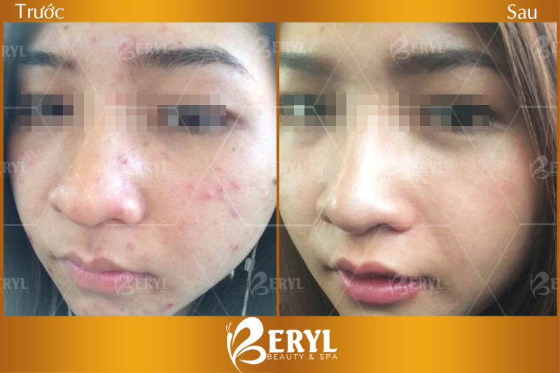 các cơ sở trị mụn uy tín các cơ sở trị mụn uy tín