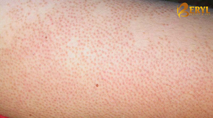 Nguyên nhân gây viêm nang lông bạn cần biết ngay tại nhà. Nguyên nhân gây viêm nang lông bạn cần biết ngay tại nhà.