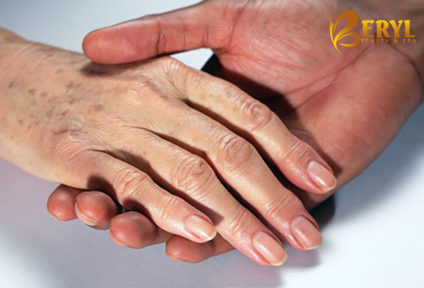Dấu hiệu nhận biết da tay bị lão hóa Dấu hiệu nhận biết da tay bị lão hóa