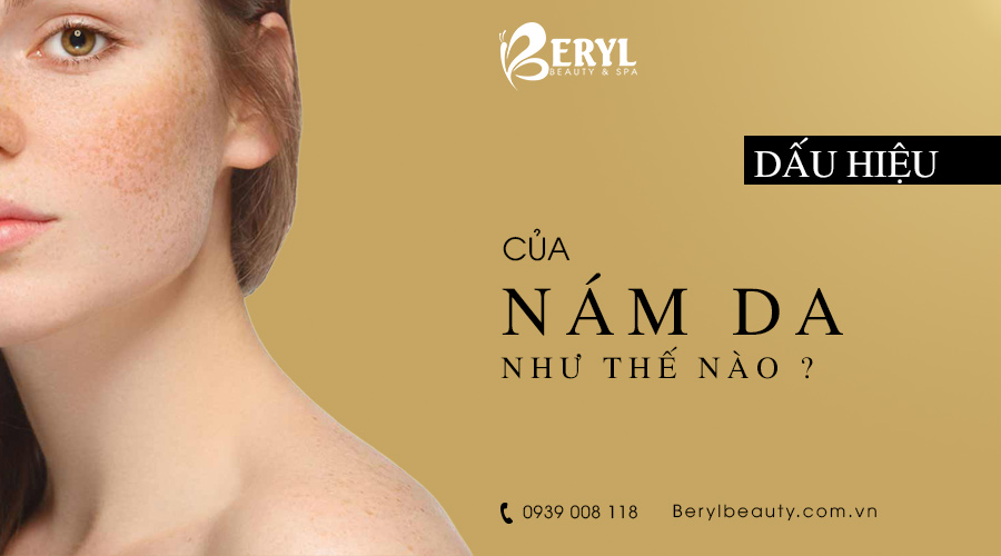Dấu hiệu của nám da là gì? Dấu hiệu của nám da là gì?