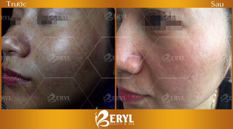 Hình ảnh trước sau điều trị nám CN Alphatech tại Beryl Beauty & Spa Hình ảnh trước sau điều trị nám CN Alphatech tại Beryl Beauty & Spa