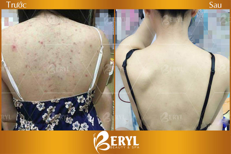 Hình ảnh điều trị thâm lưng tại Beryl Beauty & Spa Hình ảnh điều trị thâm lưng tại Beryl Beauty & Spa