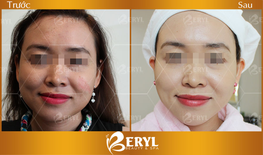 Hình ảnh trước và sau khi nâng cơ mặt, trẻ hóa da tại Beryl Beauty & Spa Hình ảnh trước và sau khi nâng cơ mặt, trẻ hóa da tại Beryl Beauty & Spa