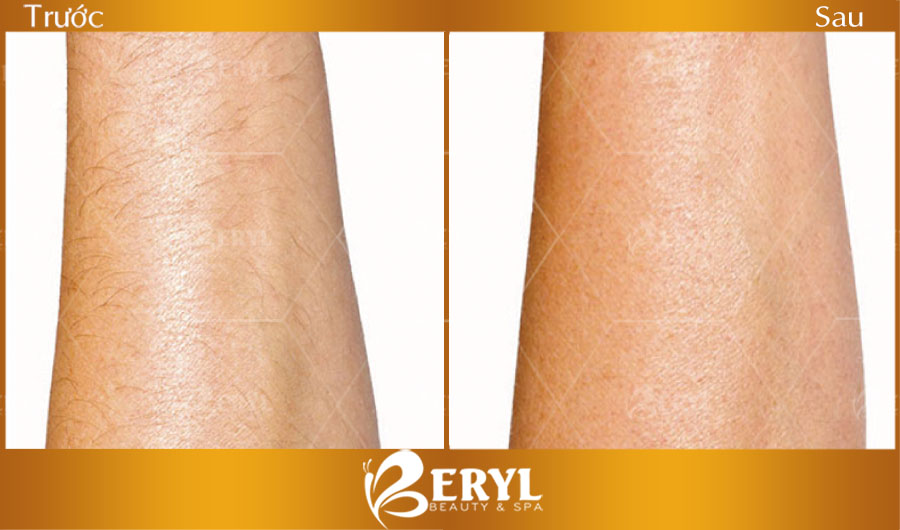 Hình ảnh trước và sau khi triệt lông cho nam giới tại Beryl Beauty & Spa Hình ảnh trước và sau khi triệt lông cho nam giới tại Beryl Beauty & Spa
