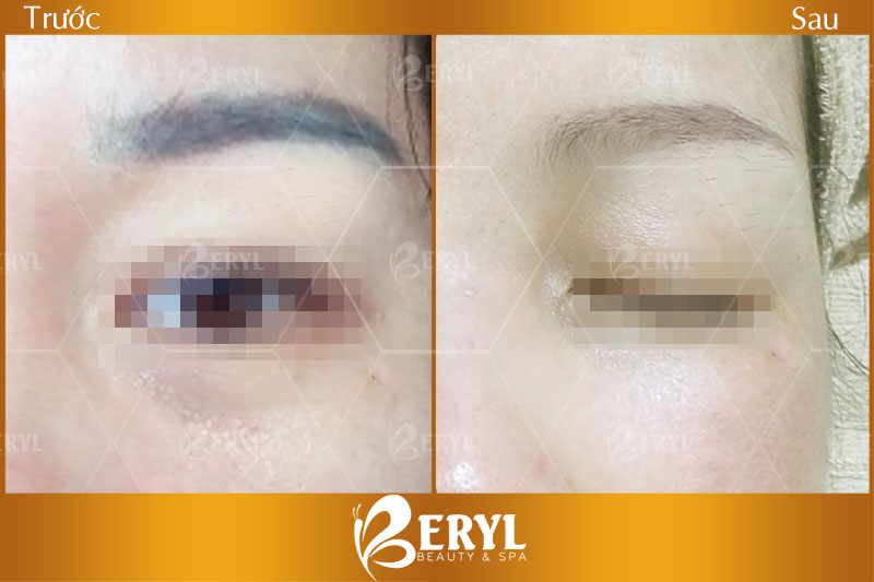 Hình ảnh trước và sau khi xóa lông mày hiệu quả tại Beryl Beauty & Spa TPHCM Hình ảnh trước và sau khi xóa lông mày hiệu quả tại Beryl Beauty & Spa TPHCM