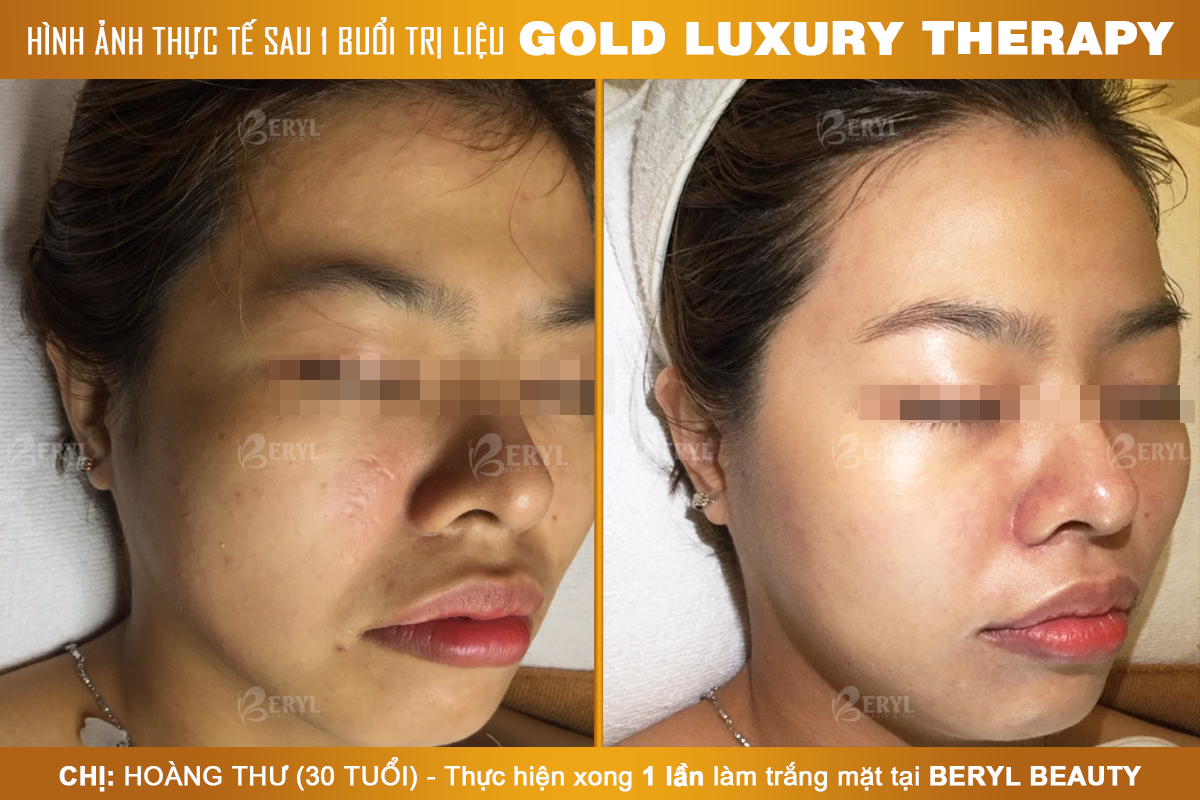 Trước và sau khi làm trắng da mặt Gold Luxury Therapy tại Beryl Beauty & Spa Trước và sau khi làm trắng da mặt Gold Luxury Therapy tại Beryl Beauty & Spa