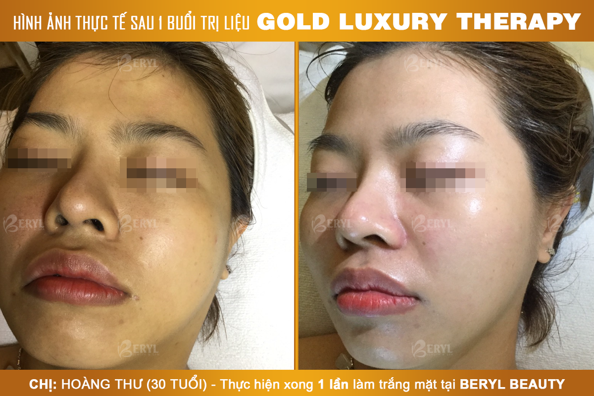 Trước và sau khi làm trắng da mặt Gold Luxury Therapy tại Beryl Beauty & Spa Trước và sau khi làm trắng da mặt Gold Luxury Therapy tại Beryl Beauty & Spa