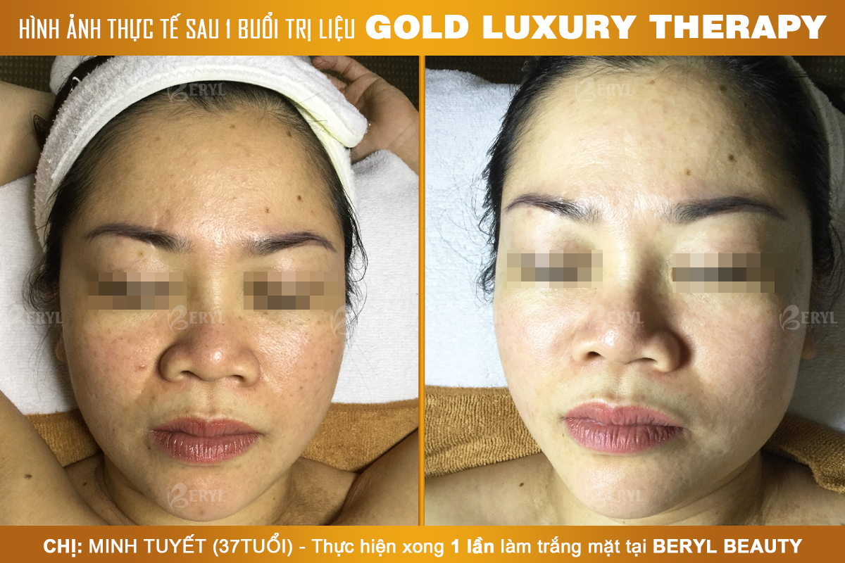 Trước và sau khi làm trắng da mặt Gold Luxury Therapy tại Beryl Beauty & Spa Trước và sau khi làm trắng da mặt Gold Luxury Therapy tại Beryl Beauty & Spa