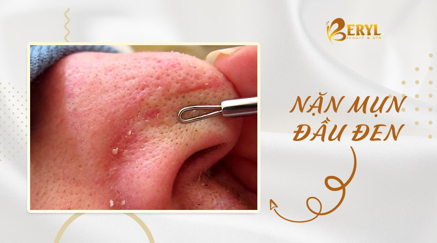 Nặn mụn đầu đen có hết hẳn mụn không? Nặn mụn đầu đen có hết hẳn mụn không?