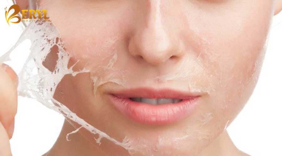 Phương pháp Peel da trị thâm mụn hiệu quả Phương pháp Peel da trị thâm mụn hiệu quả