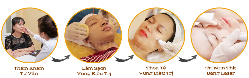 Quy trình điều trị mụn thịt bằng công nghệ Laser Co2 Quy trình điều trị mụn thịt bằng công nghệ Laser Co2