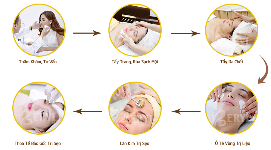 Quy trình điều trị sẹo rỗ bằng công nghệ lăn kim tế bào gốc tại Beryl Beauty & Spa Quy trình điều trị sẹo rỗ bằng công nghệ lăn kim tế bào gốc tại Beryl Beauty & Spa