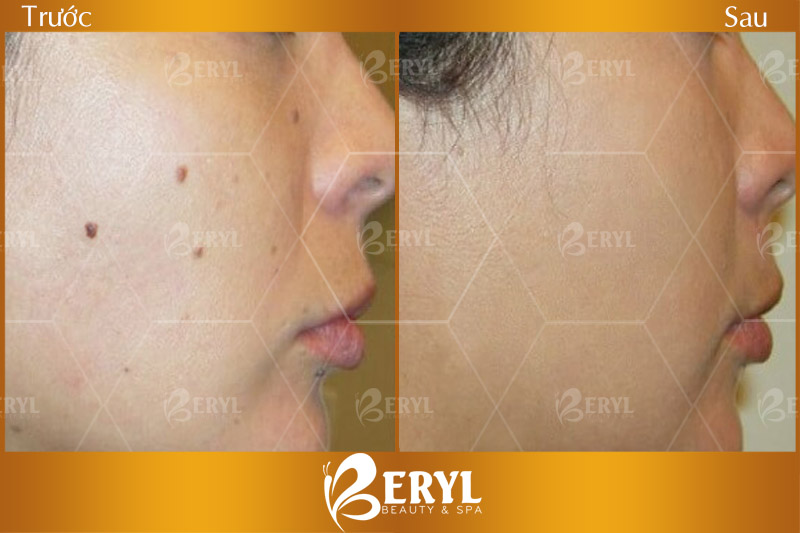 tẩy-nốt-ruồi-ở-đâu tẩy-nốt-ruồi-ở-đâu