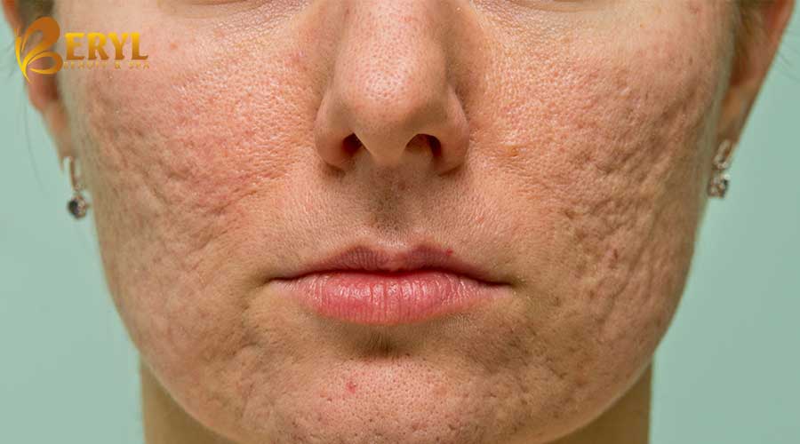 Sẹo rỗ là hậu quả nặng của những cụm mụn mủ lớn để lại Sẹo rỗ là hậu quả nặng của những cụm mụn mủ lớn để lại