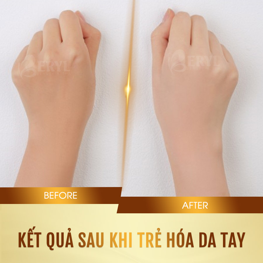 Hình ảnh trước và sau khi chăm sóc dưỡng trẻ hóa da bàn tay của khách hàng tại Beryl Beauty Hình ảnh trước và sau khi chăm sóc dưỡng trẻ hóa da bàn tay của khách hàng tại Beryl Beauty