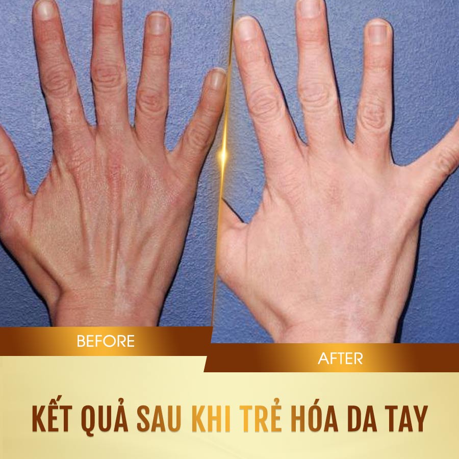 Hình ảnh trước và sau khi chăm sóc dưỡng trẻ hóa da bàn tay của khách hàng tại Beryl Beauty Hình ảnh trước và sau khi chăm sóc dưỡng trẻ hóa da bàn tay của khách hàng tại Beryl Beauty