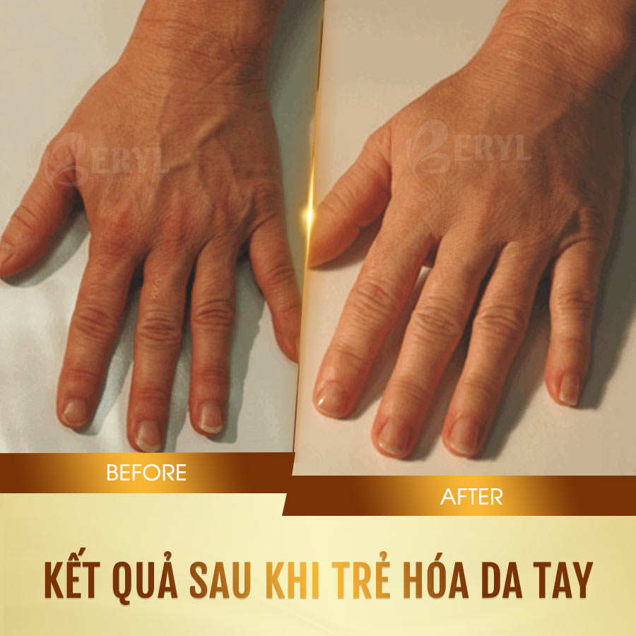Hình ảnh trước và sau khi chăm sóc dưỡng trẻ hóa da bàn tay của khách hàng tại Beryl Beauty Hình ảnh trước và sau khi chăm sóc dưỡng trẻ hóa da bàn tay của khách hàng tại Beryl Beauty
