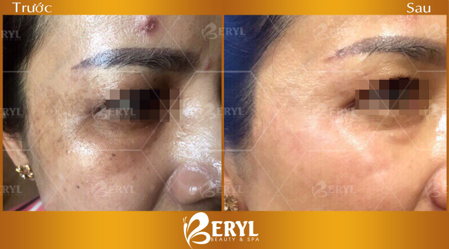 Hình ảnh trước sau điều trị nám CN Alphatech tại Beryl Beauty & Spa Hình ảnh trước sau điều trị nám CN Alphatech tại Beryl Beauty & Spa