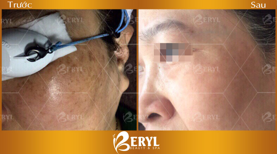 Hình ảnh trước sau điều trị nám CN Alphatech tại Beryl Beauty & Spa Hình ảnh trước sau điều trị nám CN Alphatech tại Beryl Beauty & Spa