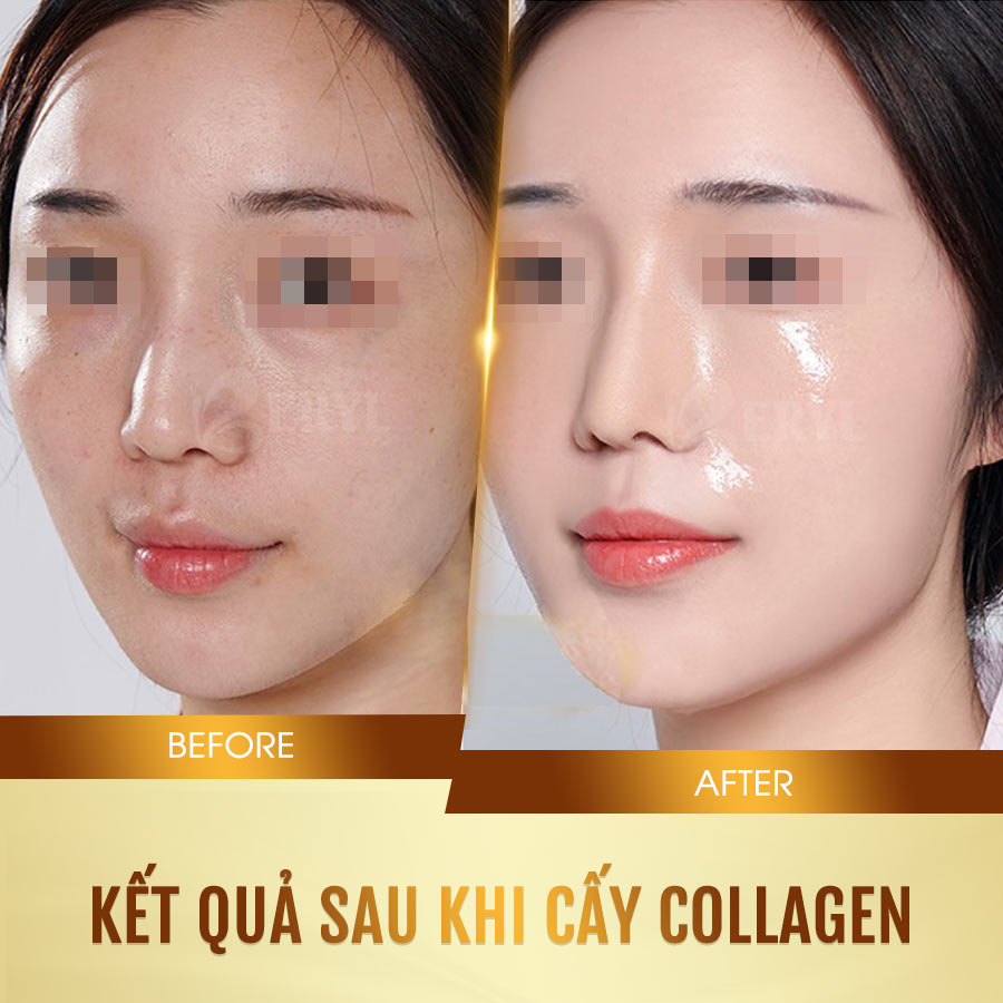 Hình ảnh trước và sau khi cấy collagen tươi căng bóng da mặt tại Beryl Beauty