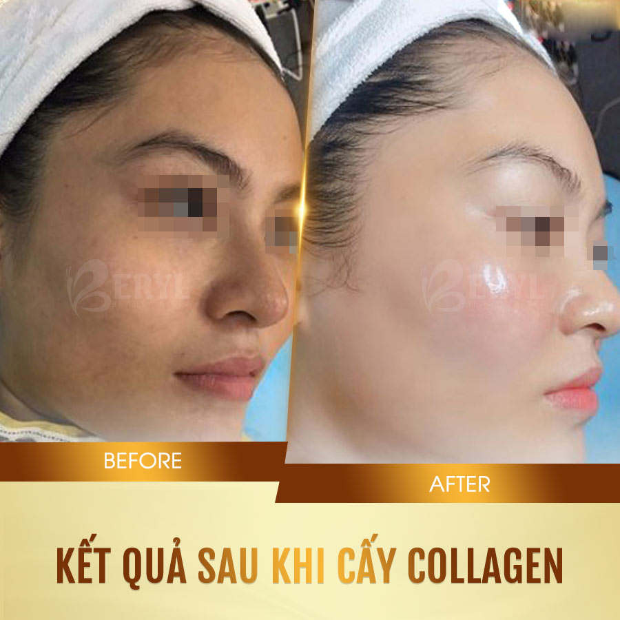 Hình ảnh trước và sau khi cấy collagen tươi căng bóng da mặt tại Beryl Beauty