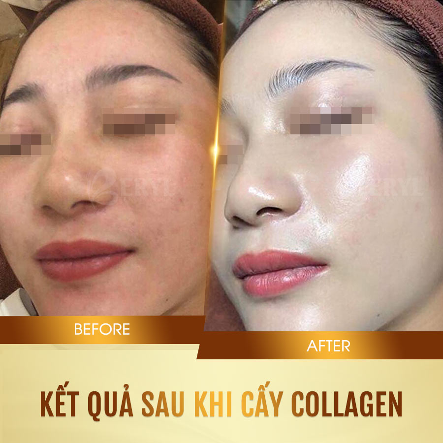 Hình ảnh trước và sau khi cấy collagen tươi căng bóng da mặt tại Beryl Beauty