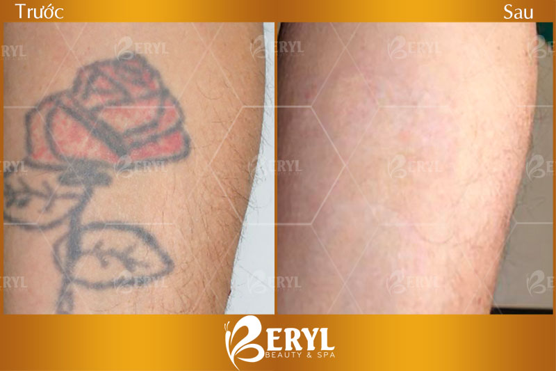 Hình ảnh trước và sau khi xóa xăm an toàn tại Beryl Beauty & Spa TPHCM Hình ảnh trước và sau khi xóa xăm an toàn tại Beryl Beauty & Spa TPHCM