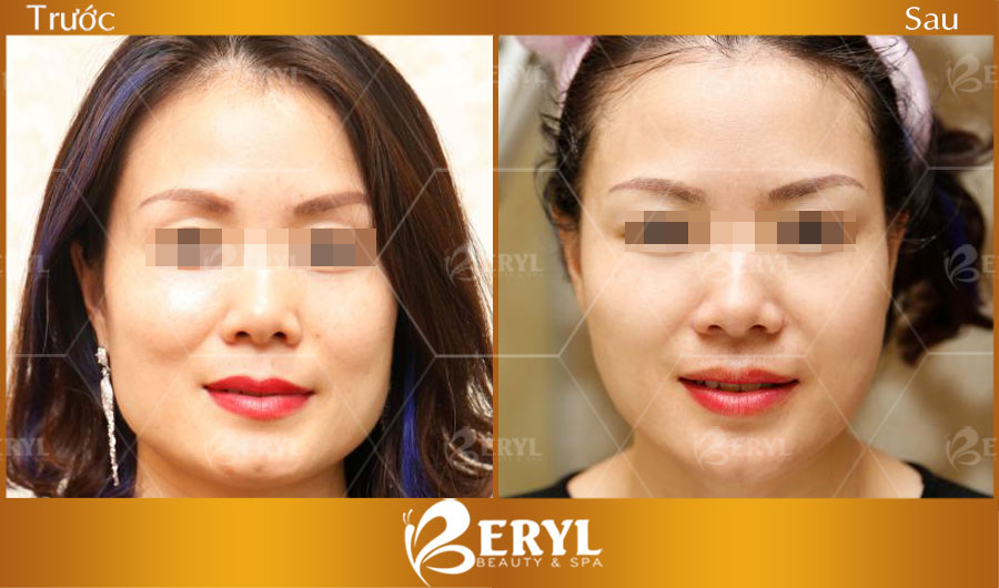 Hình ảnh trước và sau khi nâng cơ mặt bằng công nghệ Ultherapy và Duet Thermage Hình ảnh trước và sau khi nâng cơ mặt bằng công nghệ Ultherapy và Duet Thermage